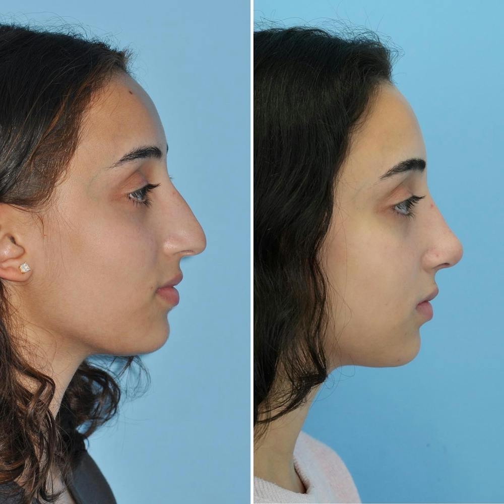 Rhinoplasty Before & After Gallery - Patient 144687138 - Image 1