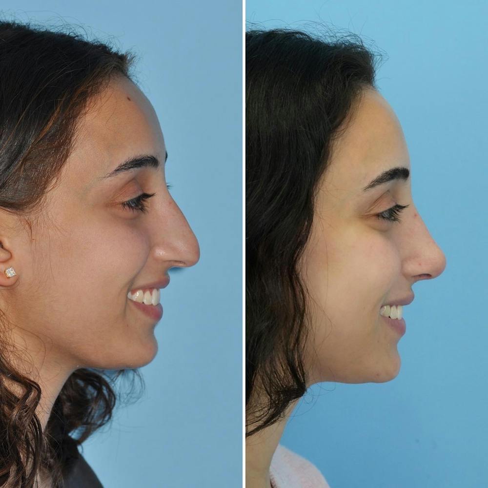 Rhinoplasty Before & After Gallery - Patient 144687138 - Image 2