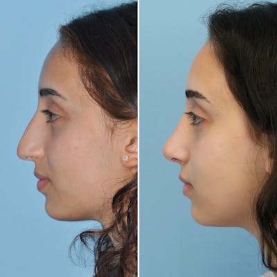 Rhinoplasty Before & After Gallery - Patient 144687138 - Image 6