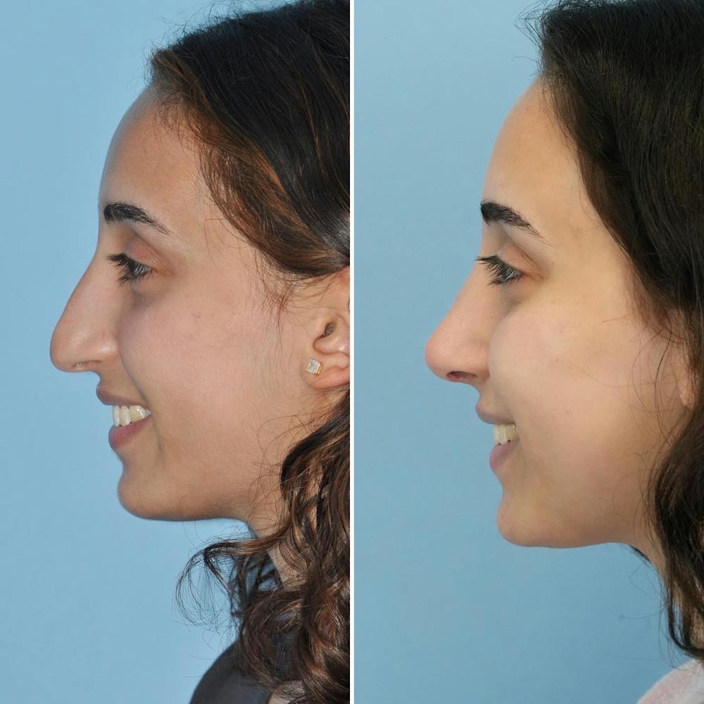 Rhinoplasty Before & After Gallery - Patient 144687138 - Image 7