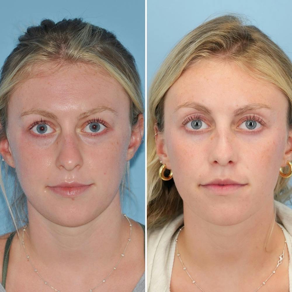 Rhinoplasty Before & After Gallery - Patient 144687123 - Image 3