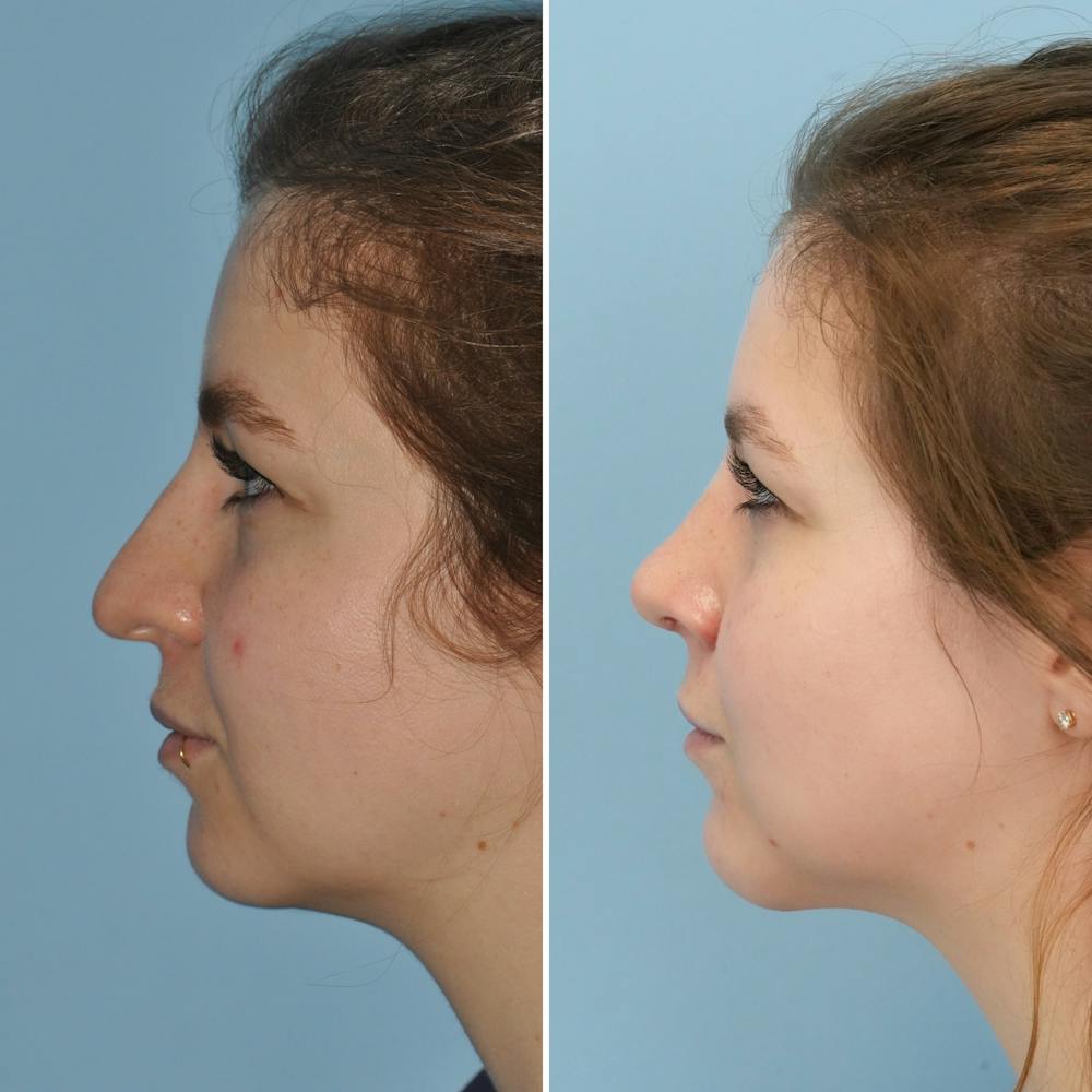 Rhinoplasty Before & After Gallery - Patient 144687139 - Image 5