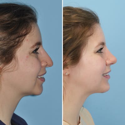 Rhinoplasty Before & After Gallery - Patient 144687139 - Image 2
