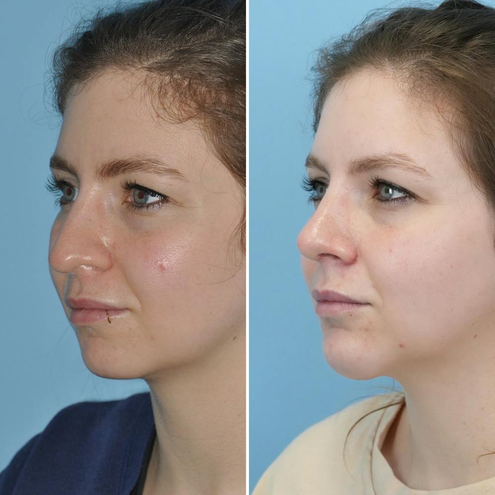 Rhinoplasty Before & After Gallery - Patient 144687139 - Image 7