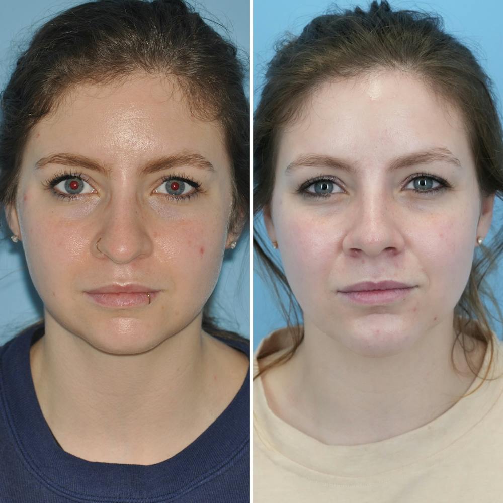 Rhinoplasty Before & After Gallery - Patient 144687139 - Image 4