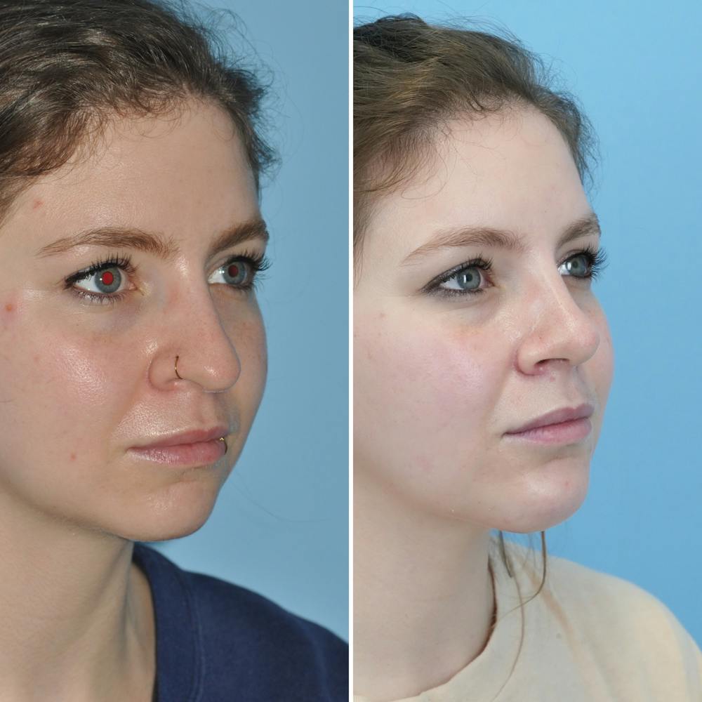 Rhinoplasty Before & After Gallery - Patient 144687139 - Image 3