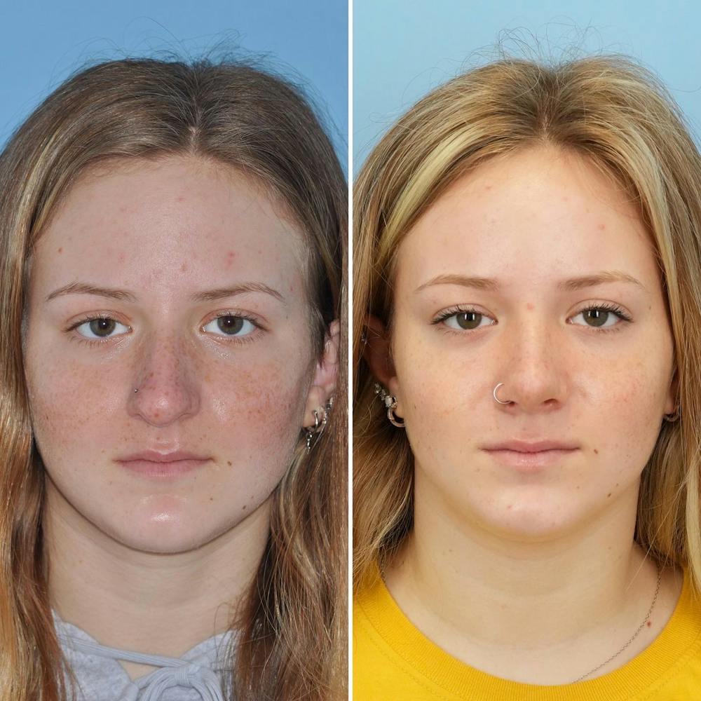 Rhinoplasty Before & After Gallery - Patient 144687141 - Image 2