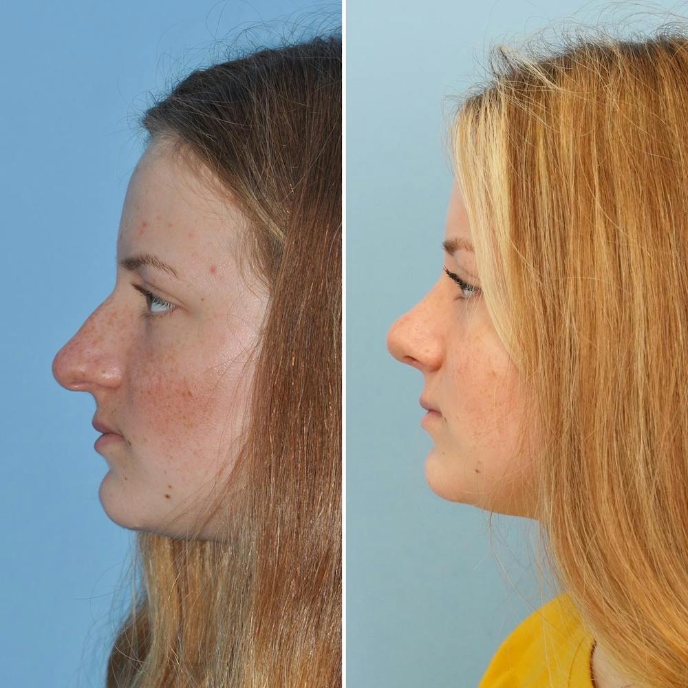 Rhinoplasty Before & After Gallery - Patient 144687141 - Image 3