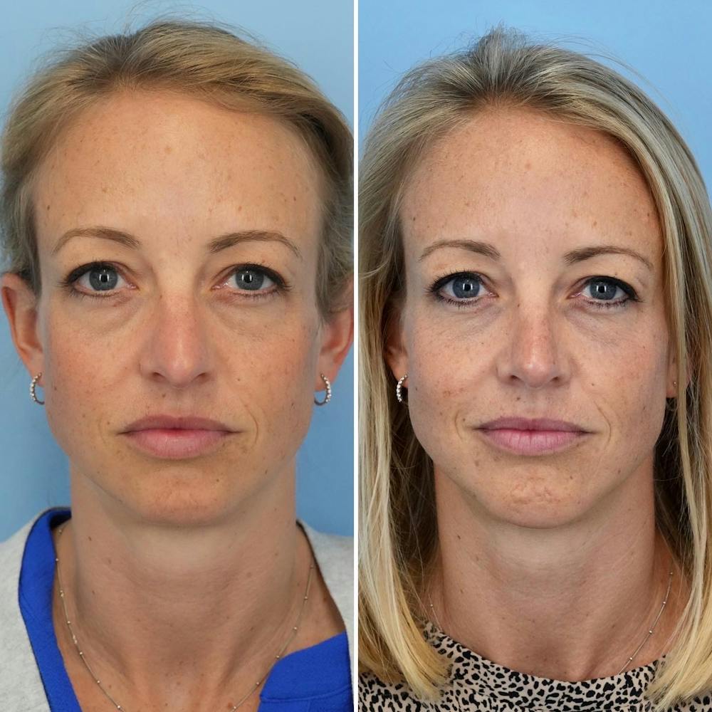 Rhinoplasty Before & After Gallery - Patient 144687144 - Image 2