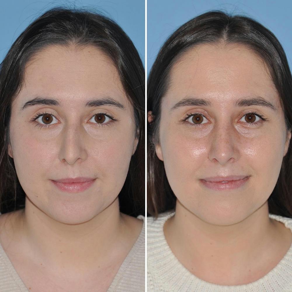 Rhinoplasty Before & After Gallery - Patient 144687145 - Image 3