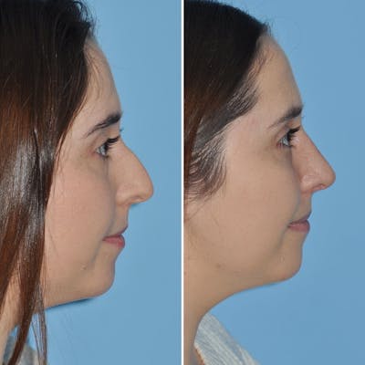 Rhinoplasty Before & After Gallery - Patient 144687145 - Image 1