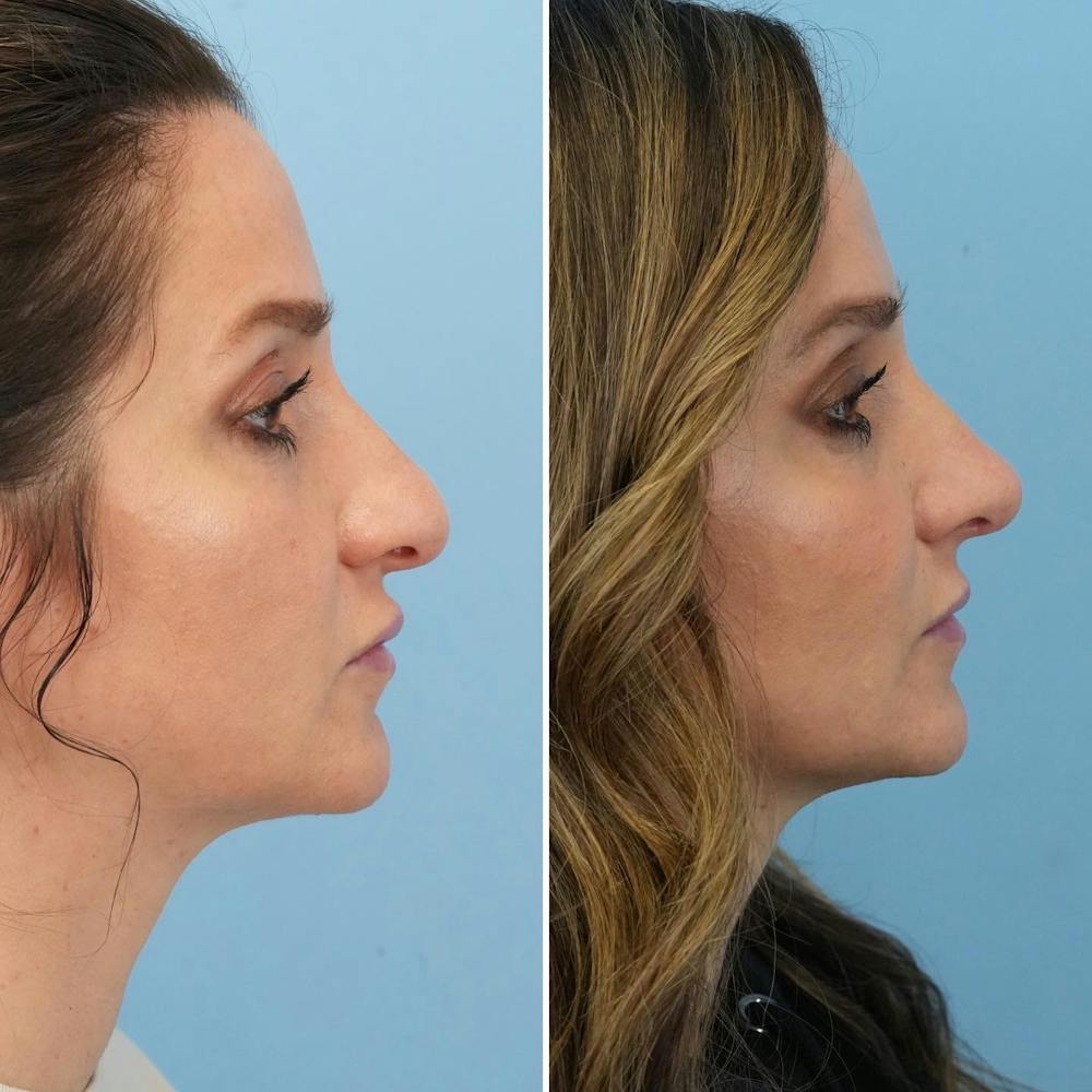 Rhinoplasty Before & After Gallery - Patient 144687147 - Image 1