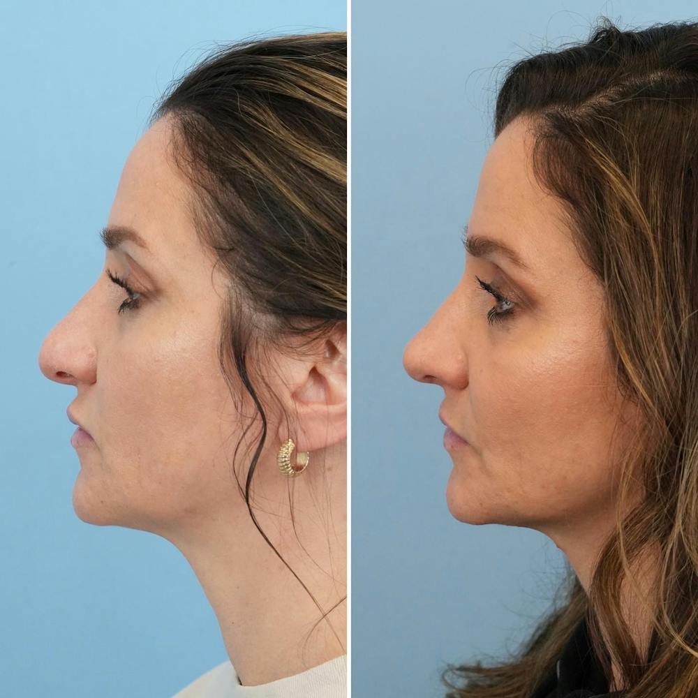 Rhinoplasty Before & After Gallery - Patient 144687147 - Image 4