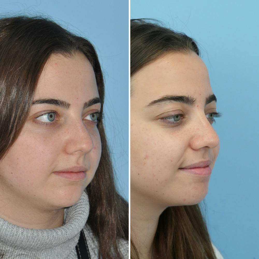 Rhinoplasty Before & After Gallery - Patient 144687148 - Image 1