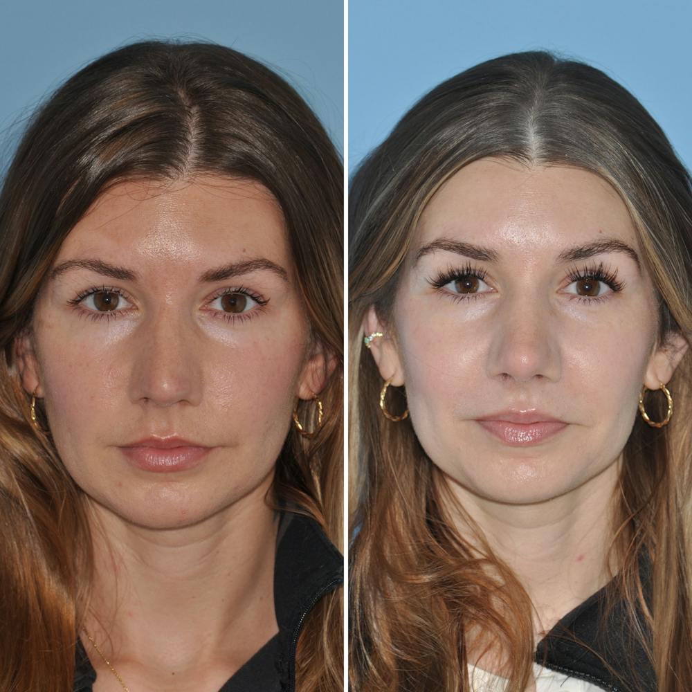 Rhinoplasty Before & After Gallery - Patient 144687150 - Image 2
