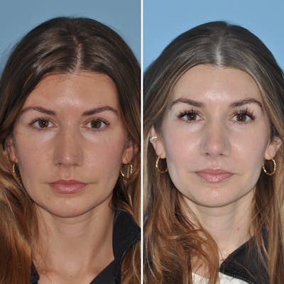 Rhinoplasty Before & After Gallery - Patient 144687150 - Image 2