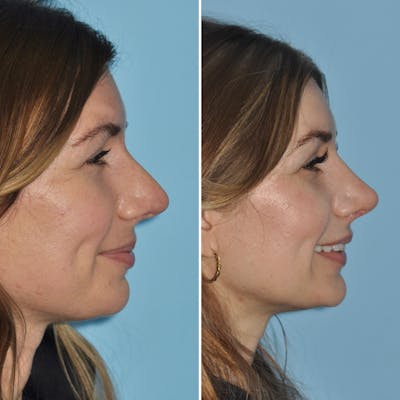 Rhinoplasty Before & After Gallery - Patient 144687150 - Image 1