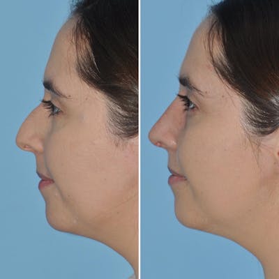 Rhinoplasty Before & After Gallery - Patient 144687145 - Image 4