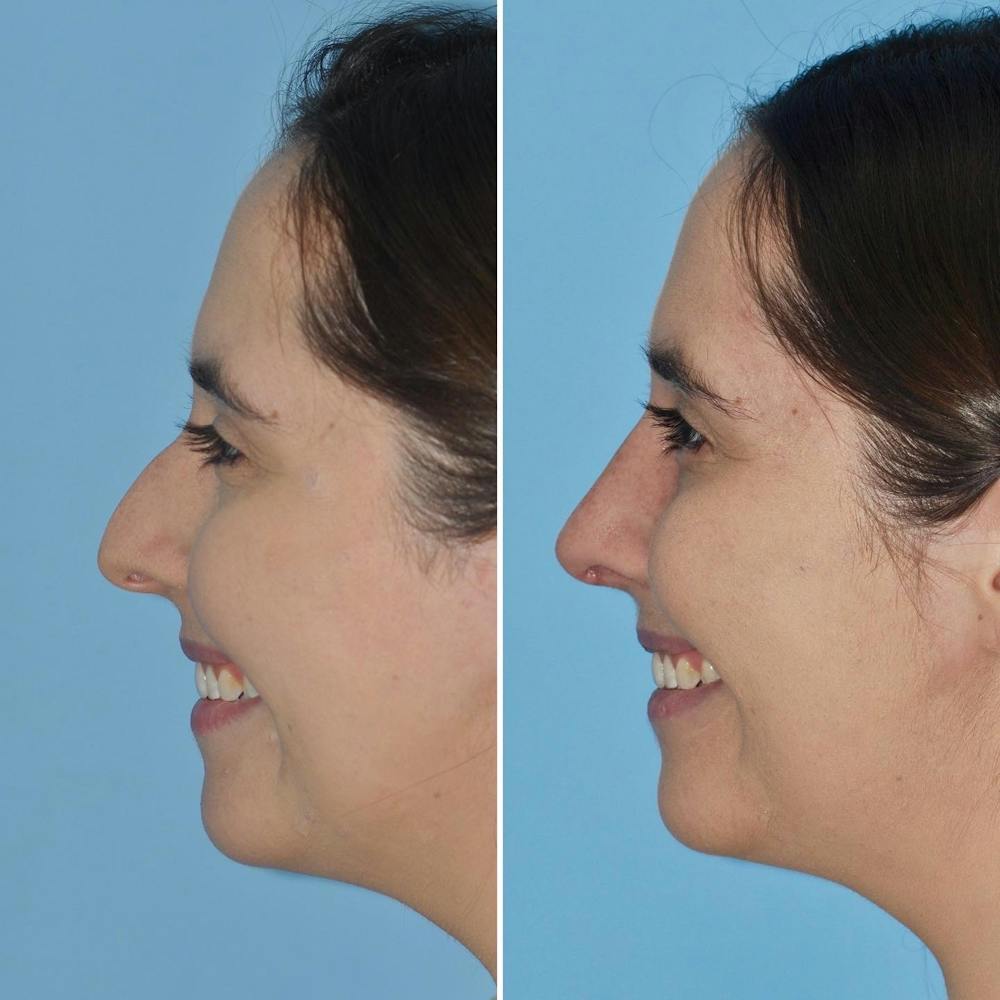 Rhinoplasty Before & After Gallery - Patient 144687145 - Image 5