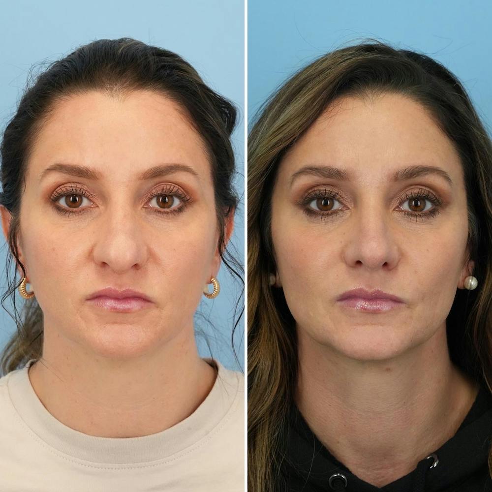 Rhinoplasty Before & After Gallery - Patient 144687147 - Image 3