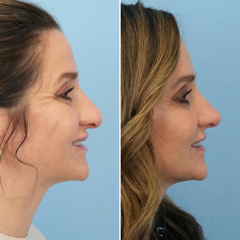 Rhinoplasty Before & After Gallery - Patient 144687147 - Image 2
