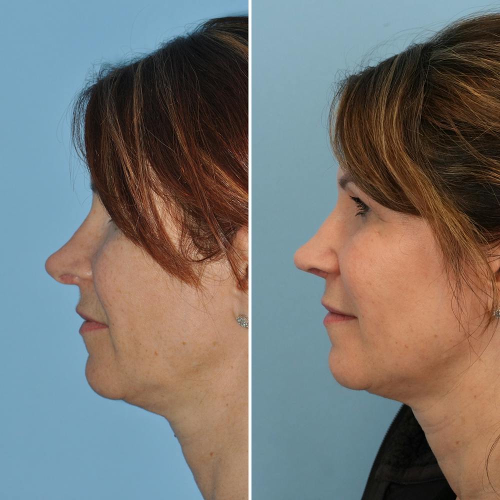 Rhinoplasty Before & After Gallery - Patient 144687152 - Image 2