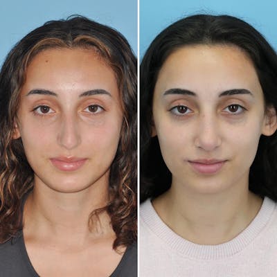 Rhinoplasty Before & After Gallery - Patient 144687138 - Image 4