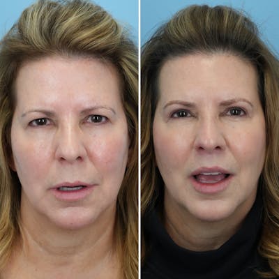 Lip Lift Before & After Gallery - Patient 144687157 - Image 1