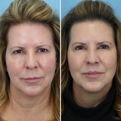 Lip Lift Before & After Gallery - Patient 144687157 - Image 2