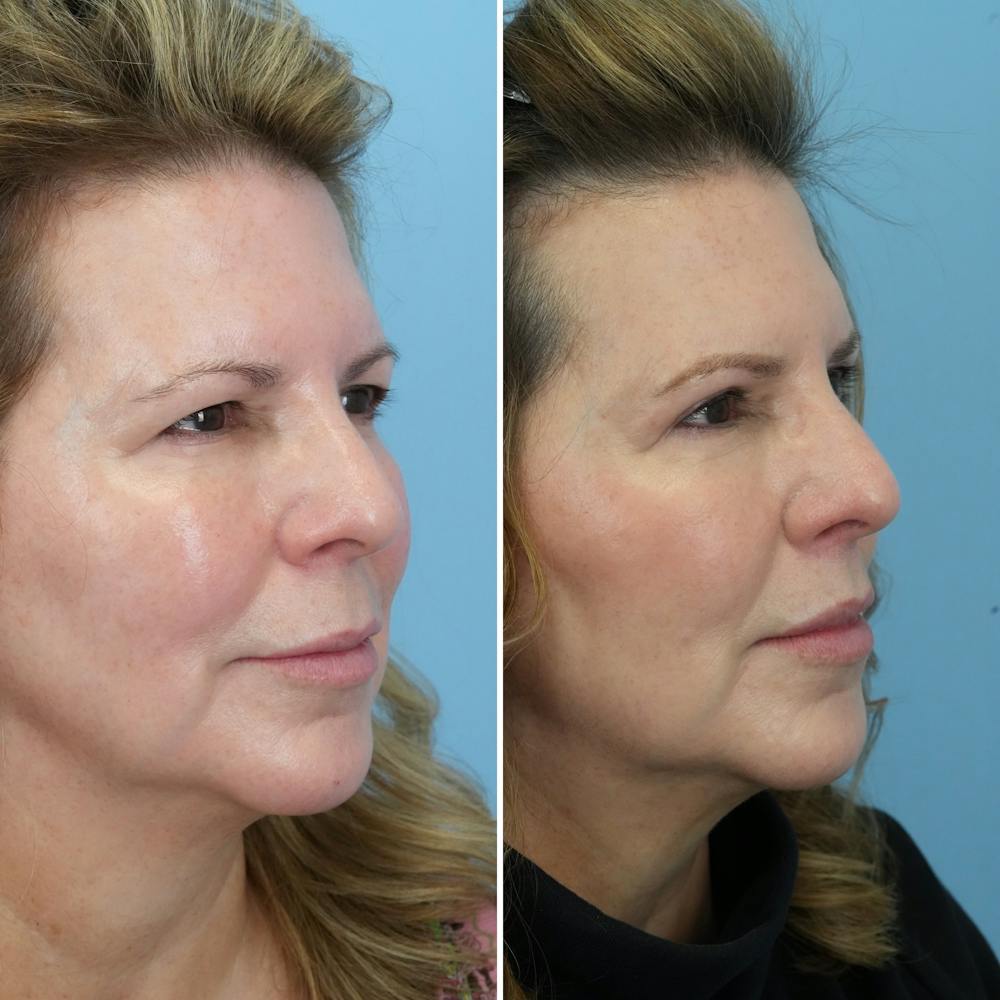 Lip Lift Before & After Gallery - Patient 144687157 - Image 3