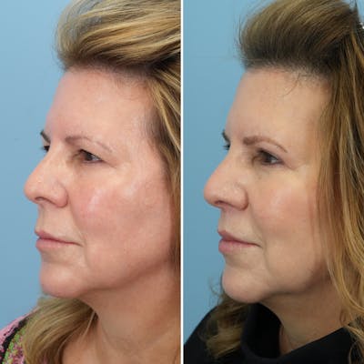 Lip Lift Before & After Gallery - Patient 144687157 - Image 4