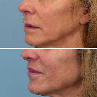 Lip Lift Before & After Gallery - Patient 144687158 - Image 2