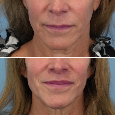 Lip Lift Before & After Gallery - Patient 144687158 - Image 1