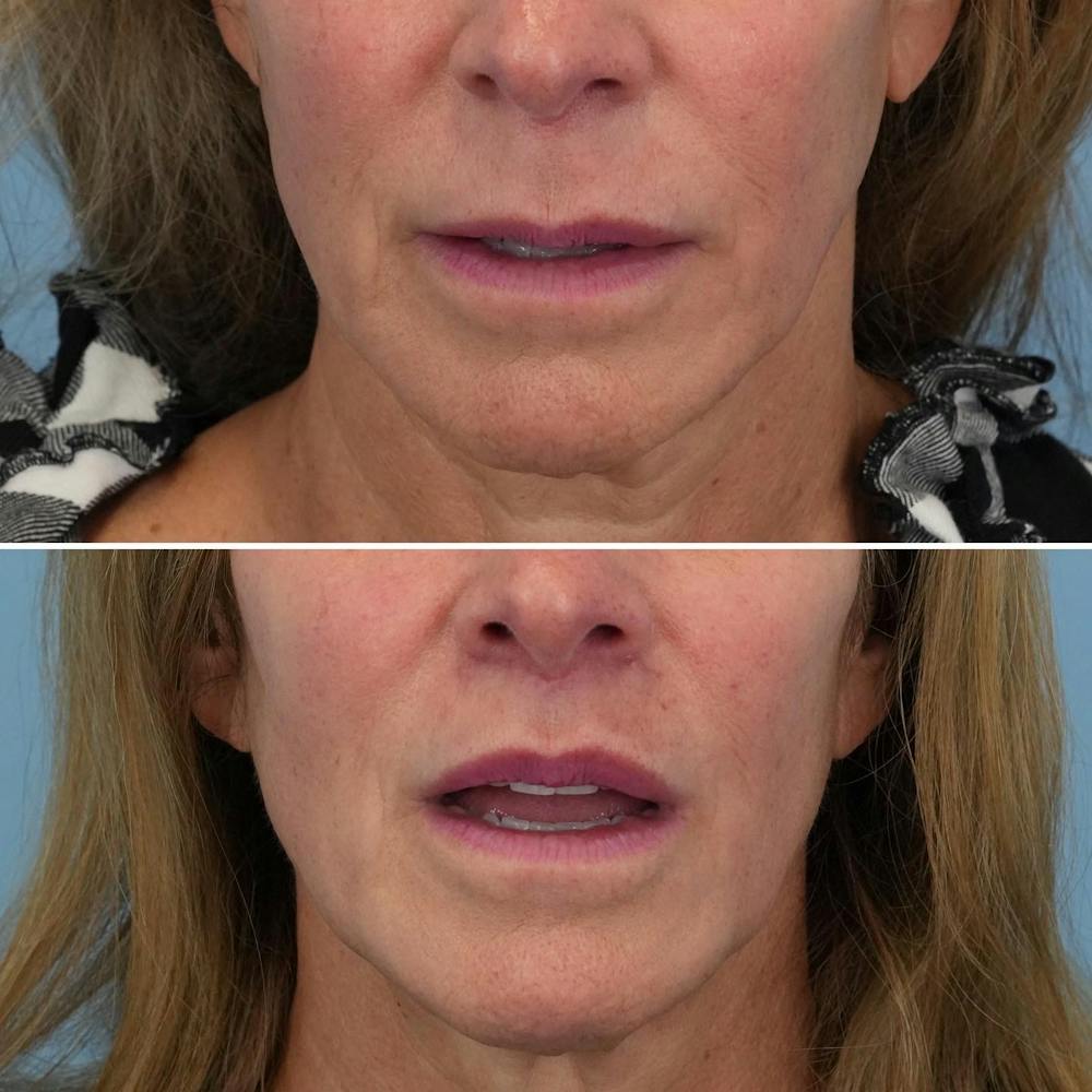 Lip Lift Before & After Gallery - Patient 144687158 - Image 3