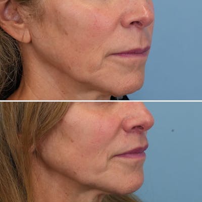 Lip Lift Before & After Gallery - Patient 144687158 - Image 4