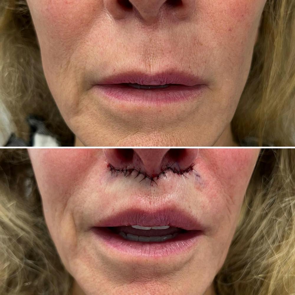 Lip Lift Before & After Gallery - Patient 144687158 - Image 5