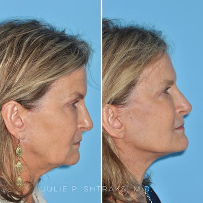 Facelift Before & After Gallery - Patient 144687165 - Image 1