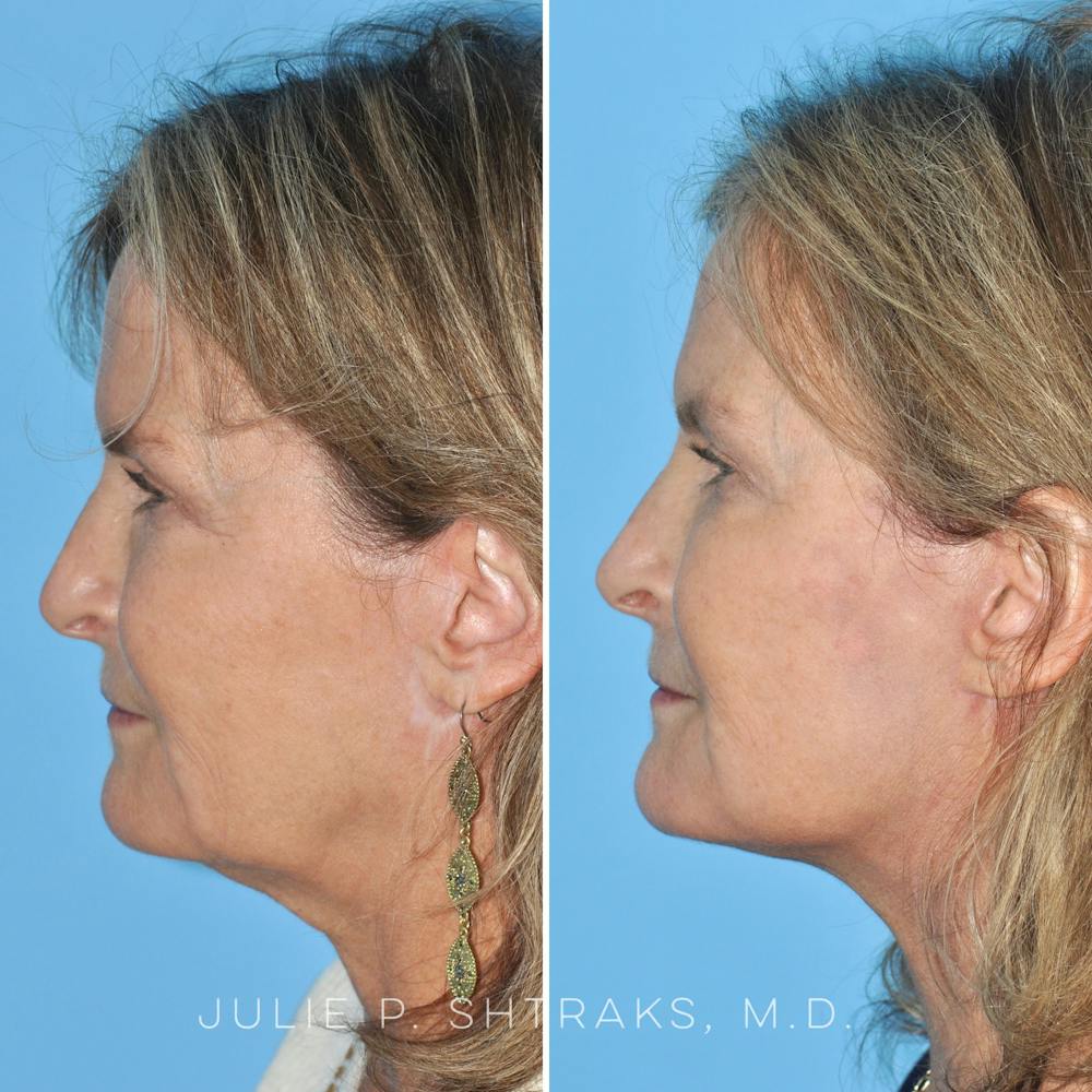 Facelift Before & After Gallery - Patient 144687165 - Image 5