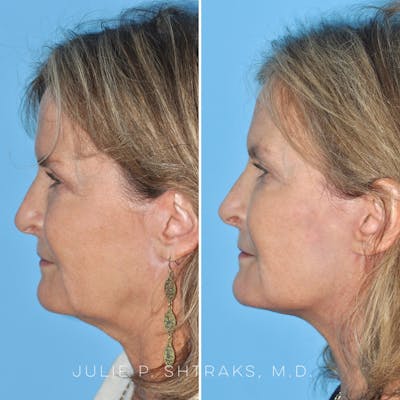 Facelift Before & After Gallery - Patient 144687165 - Image 2