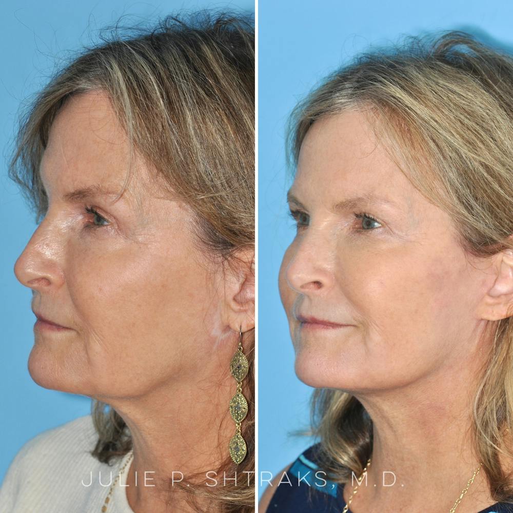 Facelift Before & After Gallery - Patient 144687165 - Image 4