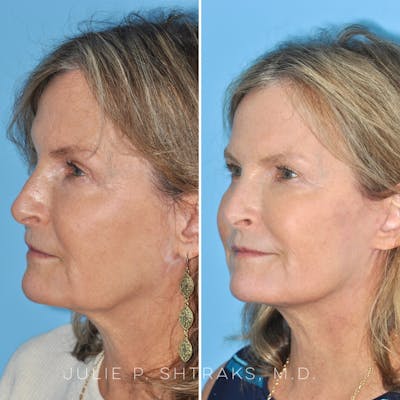 Facelift Before & After Gallery - Patient 144687165 - Image 4