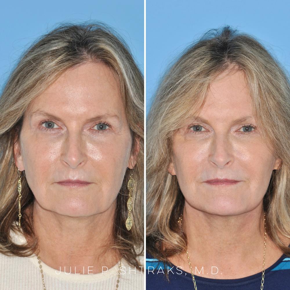 Facelift Before & After Gallery - Patient 144687165 - Image 1