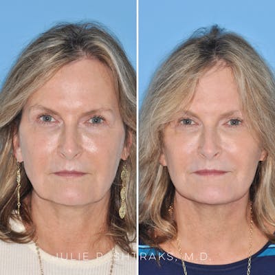 Facelift Before & After Gallery - Patient 144687165 - Image 1