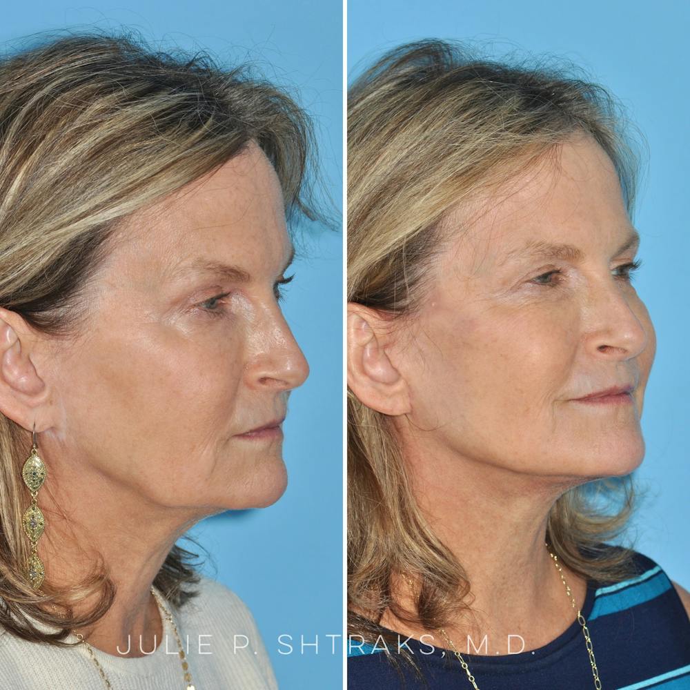 Facelift Before & After Gallery - Patient 144687165 - Image 5