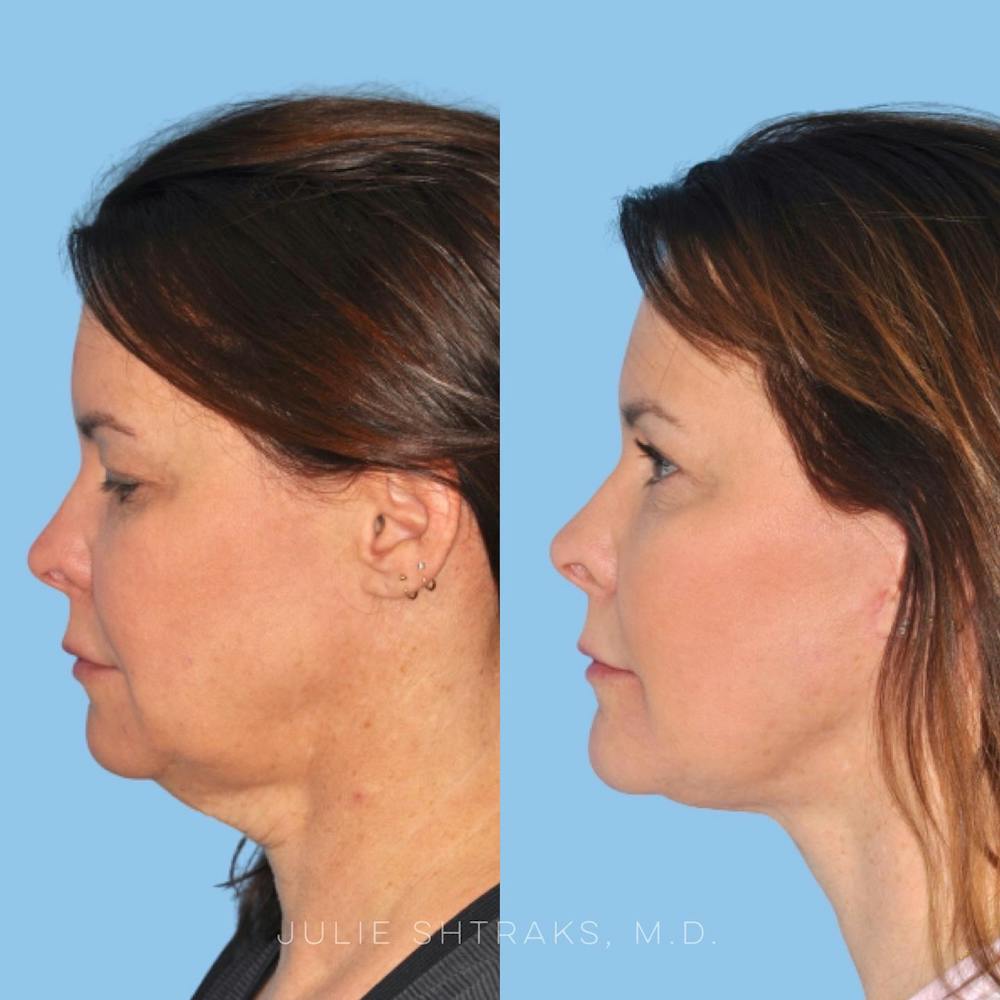 Facelift Before & After Gallery - Patient 144687166 - Image 3