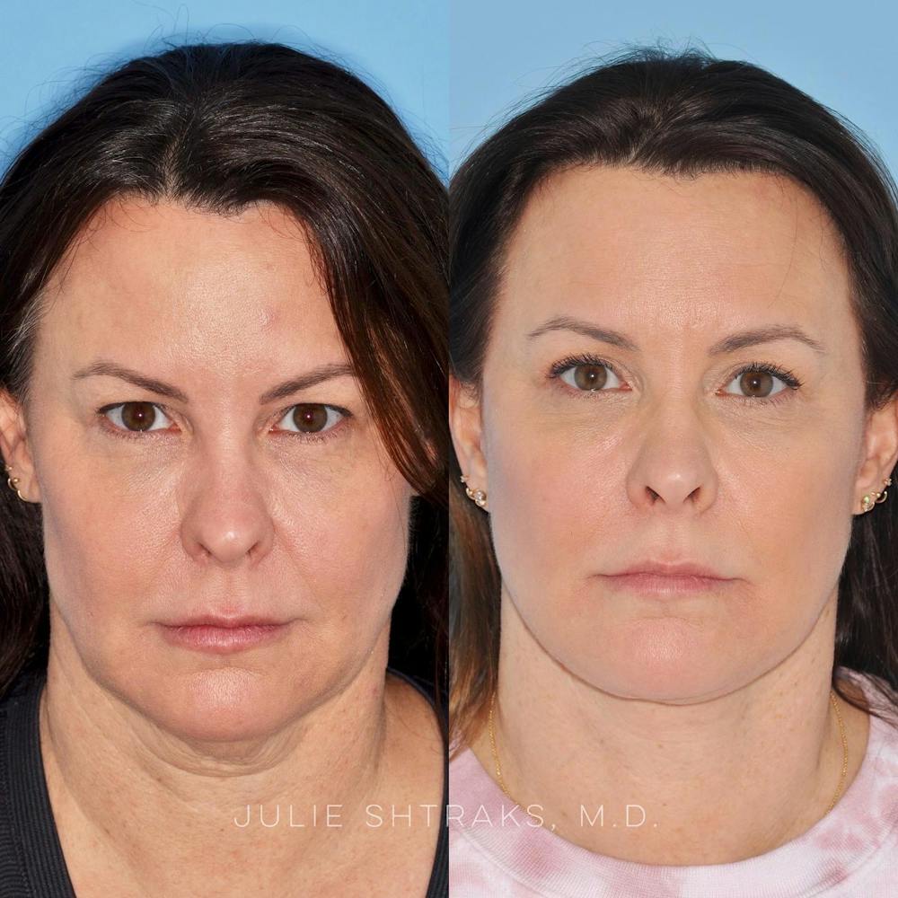 Facelift Before & After Gallery - Patient 144687166 - Image 1