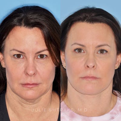 Facelift Before & After Gallery - Patient 144687166 - Image 1