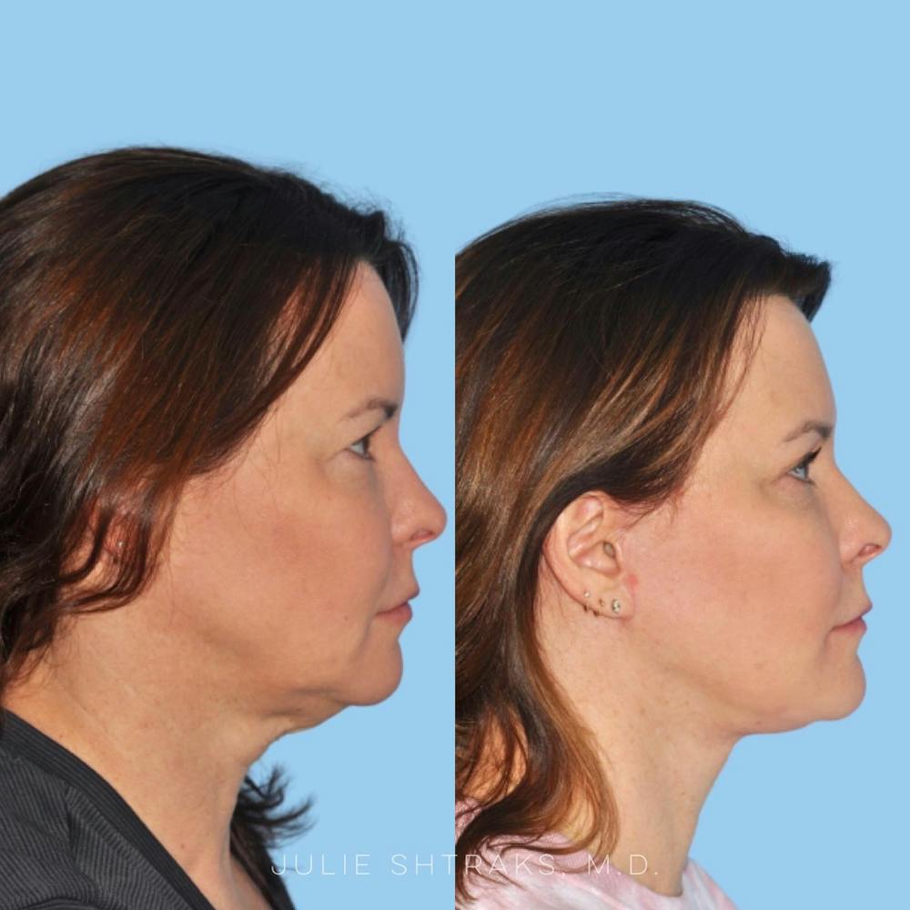 Facelift Before & After Gallery - Patient 144687166 - Image 1