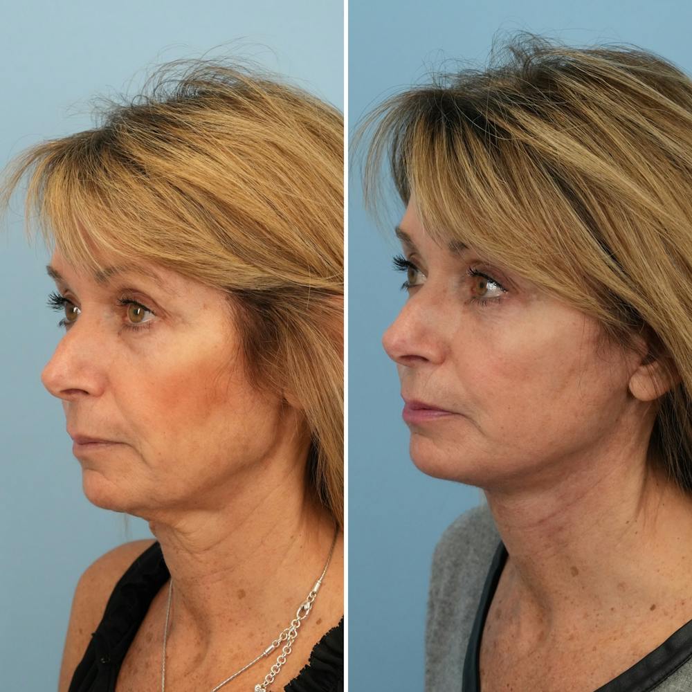 Facelift Before & After Gallery - Patient 144687167 - Image 3