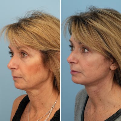 Facelift Before & After Gallery - Patient 144687167 - Image 4